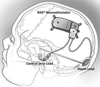 NeuroPace